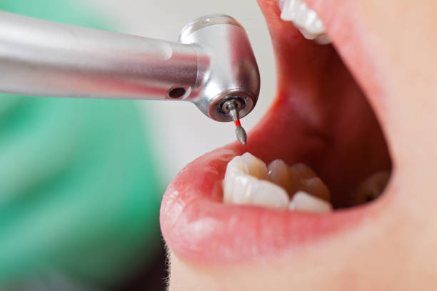 Best Knocked-Out Tooth (Avulsed Tooth) Treatment in Taos Pueblo, NM